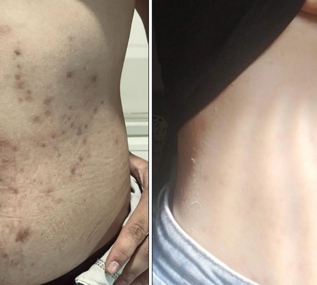 Mancha corporal antes e depois do Protocolo Pele Prime
