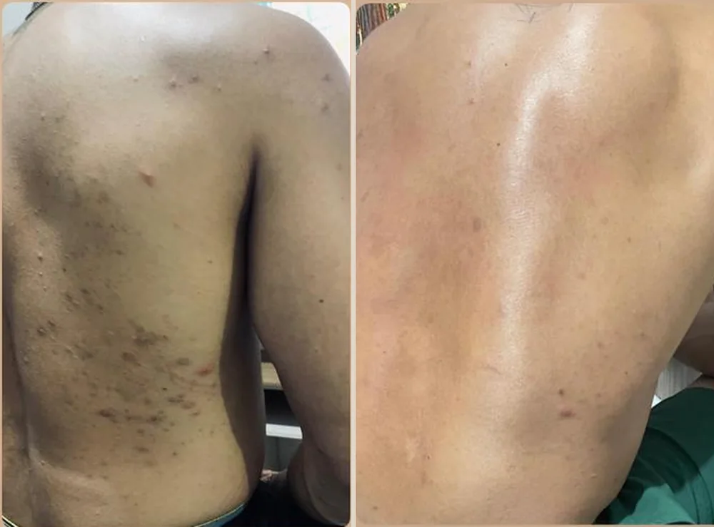 Acne nas costas antes e depois do tratamento