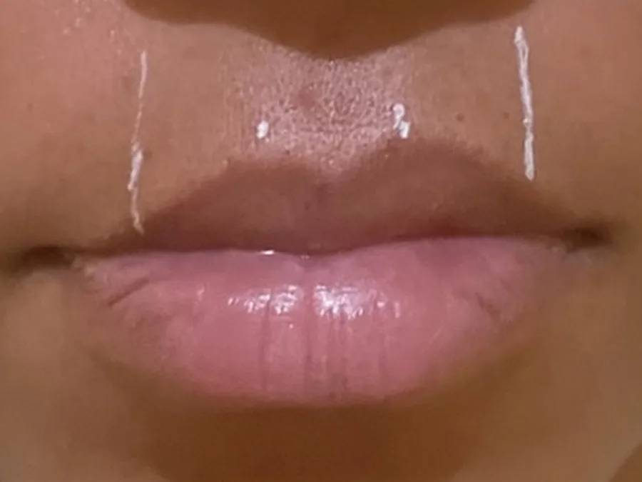 Preenchimento labial, antes