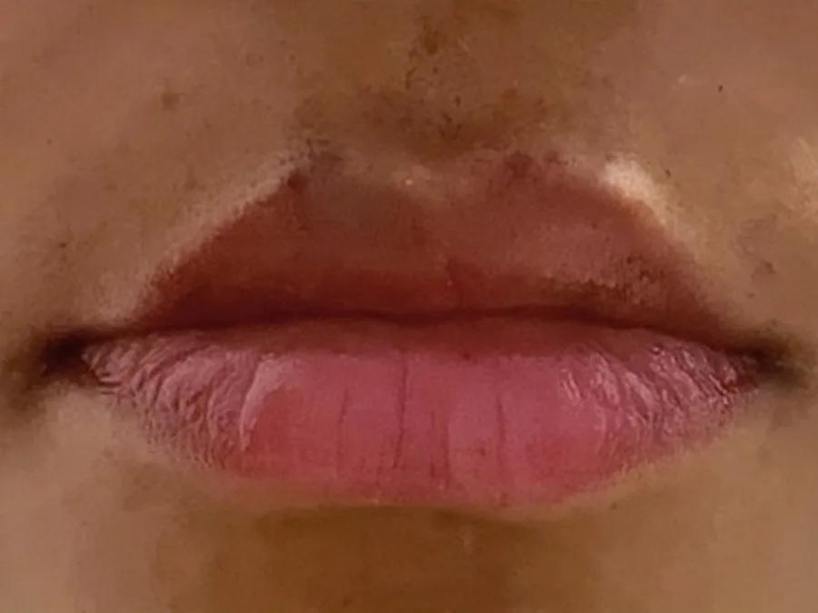 Preenchimento labial, depois