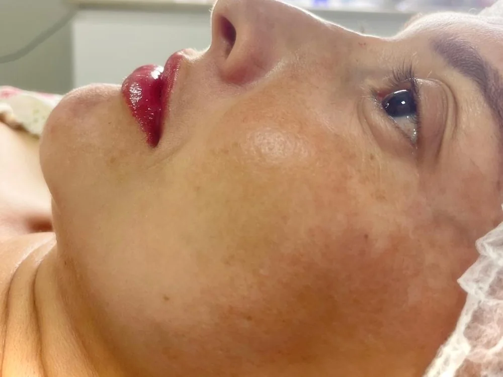 Preenchimento labial, depois