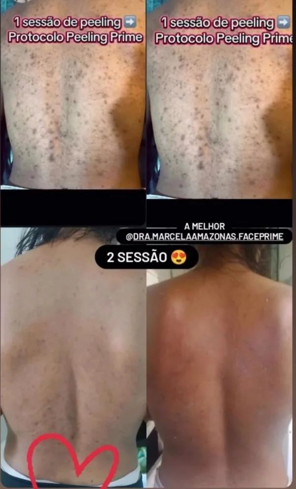 Acne nas costas, 1ª e 2ª sessão