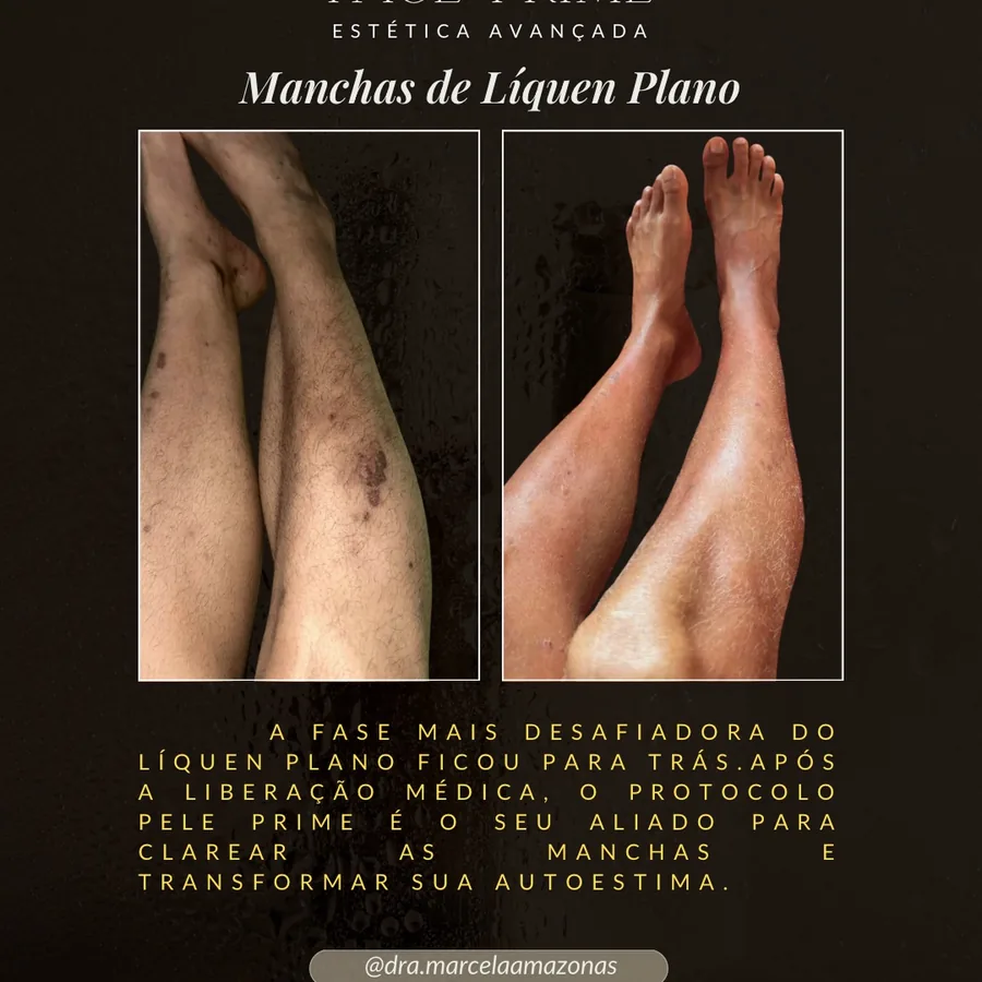 Manchas de líquen plano
