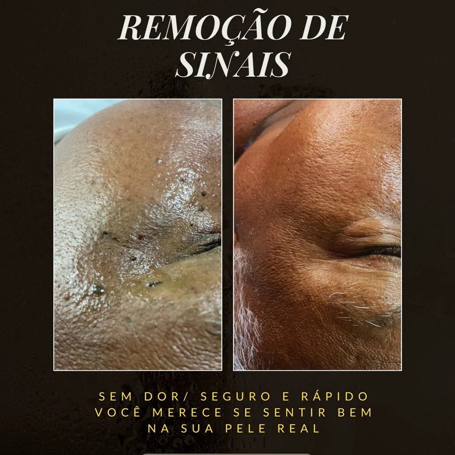 Remoção de sinais